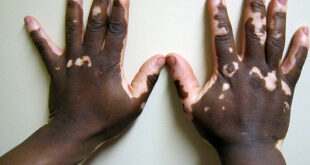 Vitiligo-Opzelura-remboursement-assurance-maladie