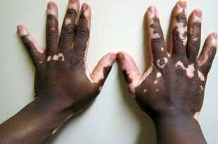 Vitiligo-Opzelura-remboursement-assurance-maladie