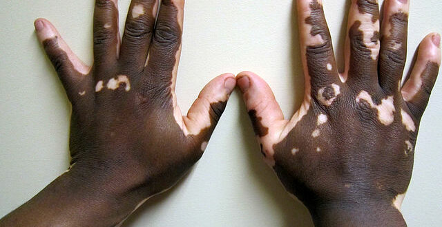 Vitiligo-Opzelura-remboursement-assurance-maladie